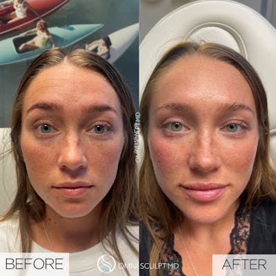 Under Eye & Cheeks Before & After Gallery - Patient 306059 - Image 1
