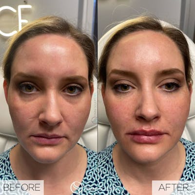 Under Eye & Cheeks Before & After Gallery - Patient 316723 - Image 1