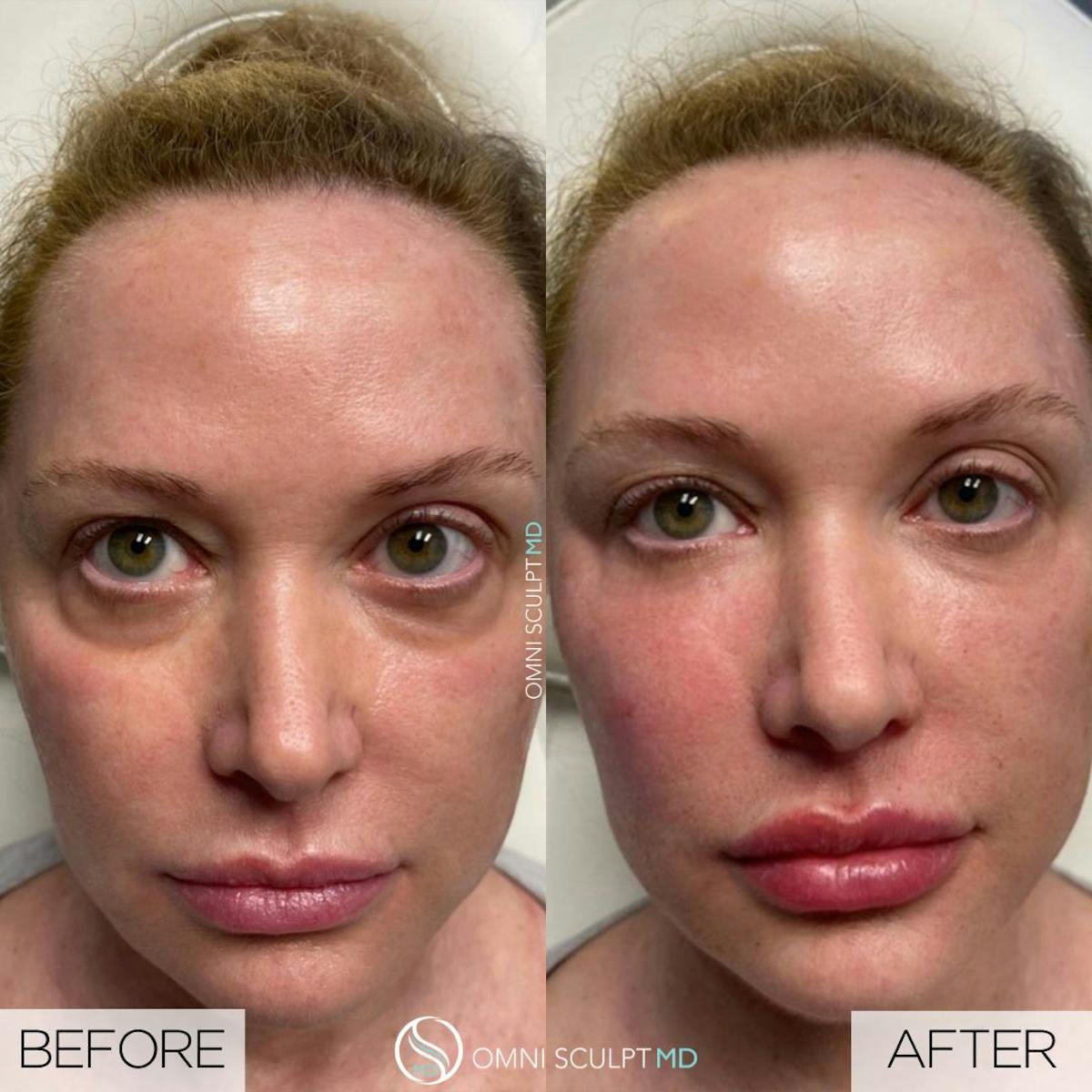 Under Eye & Cheeks Before & After Gallery - Patient 413466 - Image 1
