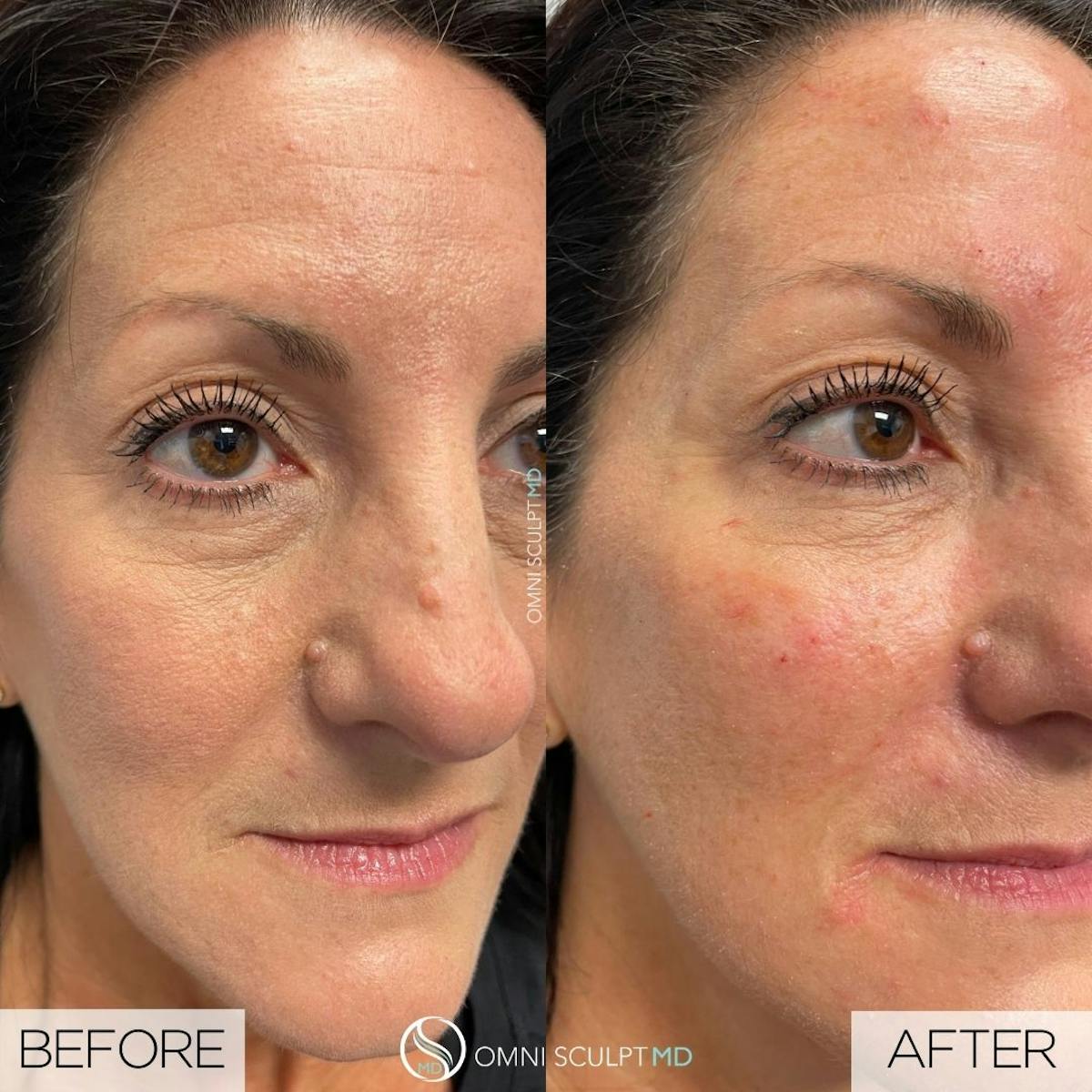 Under Eye & Cheeks Before & After Gallery - Patient 250333 - Image 1