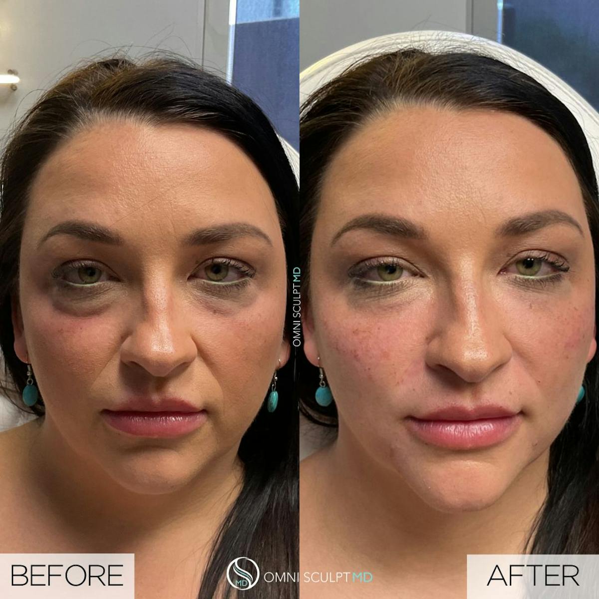 Under Eye & Cheeks Before & After Gallery - Patient 158297 - Image 1