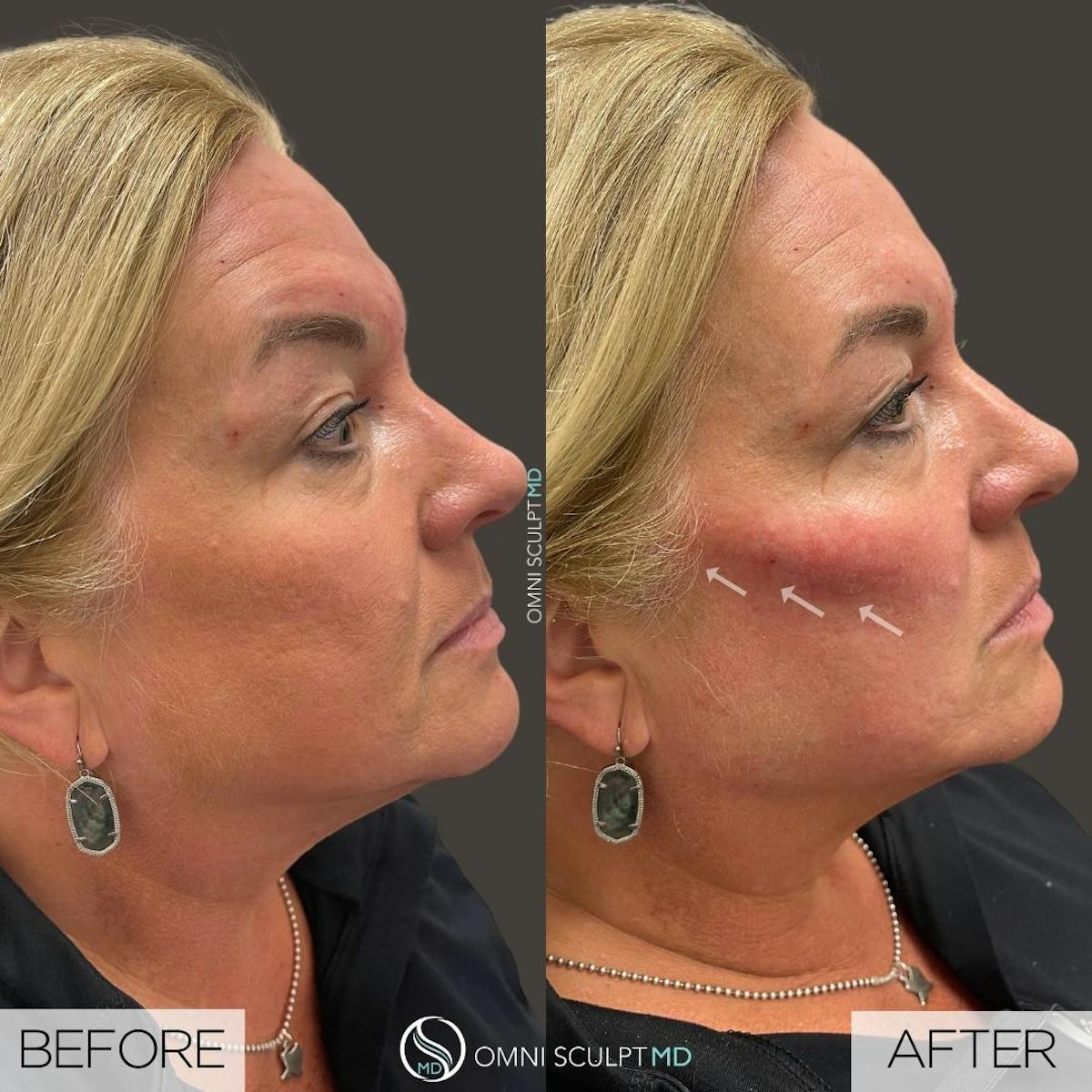 Under Eye & Cheeks Before & After Gallery - Patient 302113 - Image 1