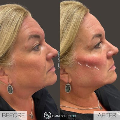 Under Eye & Cheeks Before & After Gallery - Patient 302113 - Image 1