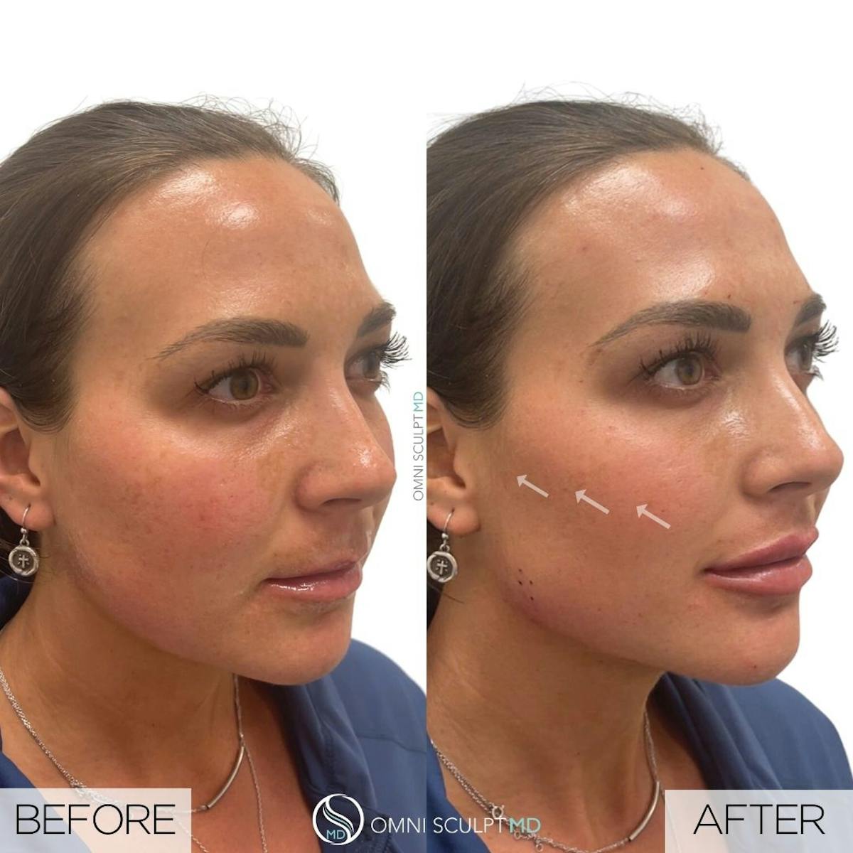 Under Eye & Cheeks Before & After Gallery - Patient 262230 - Image 1