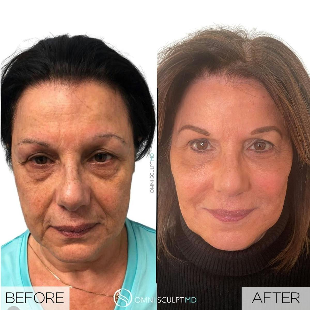 Under Eye & Cheeks Before & After Gallery - Patient 323243 - Image 1