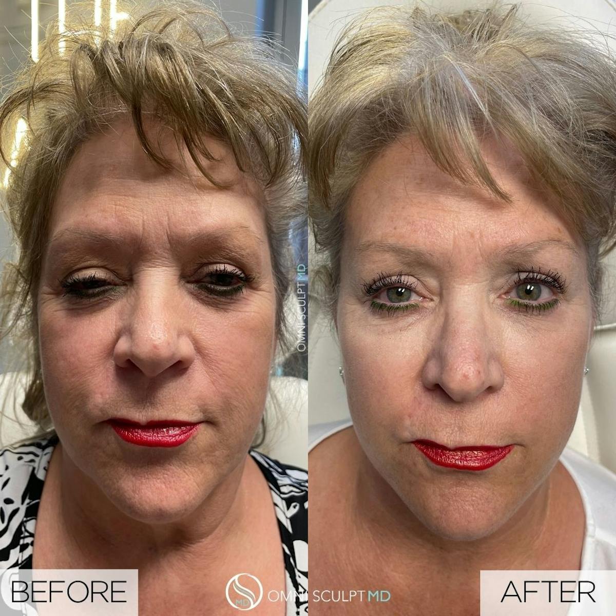 Under Eye & Cheeks Before & After Gallery - Patient 260795 - Image 1