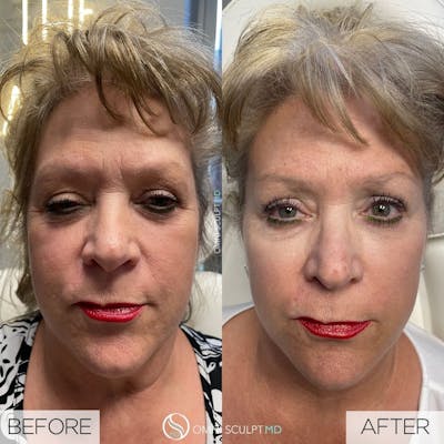 Under Eye & Cheeks Before & After Gallery - Patient 260795 - Image 1
