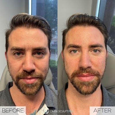 Under Eye & Cheeks Before & After Gallery - Patient 276413 - Image 1