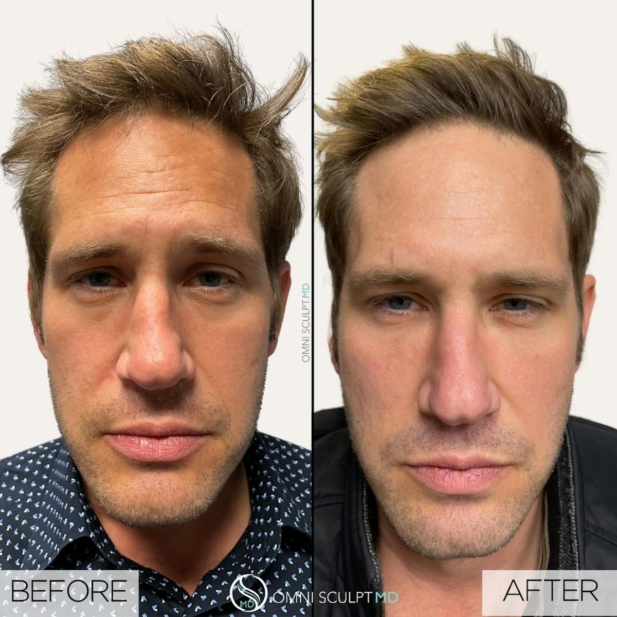 Under Eye & Cheeks Before & After Gallery - Patient 179725 - Image 1