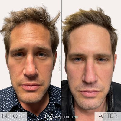 Under Eye & Cheeks Before & After Gallery - Patient 179725 - Image 1