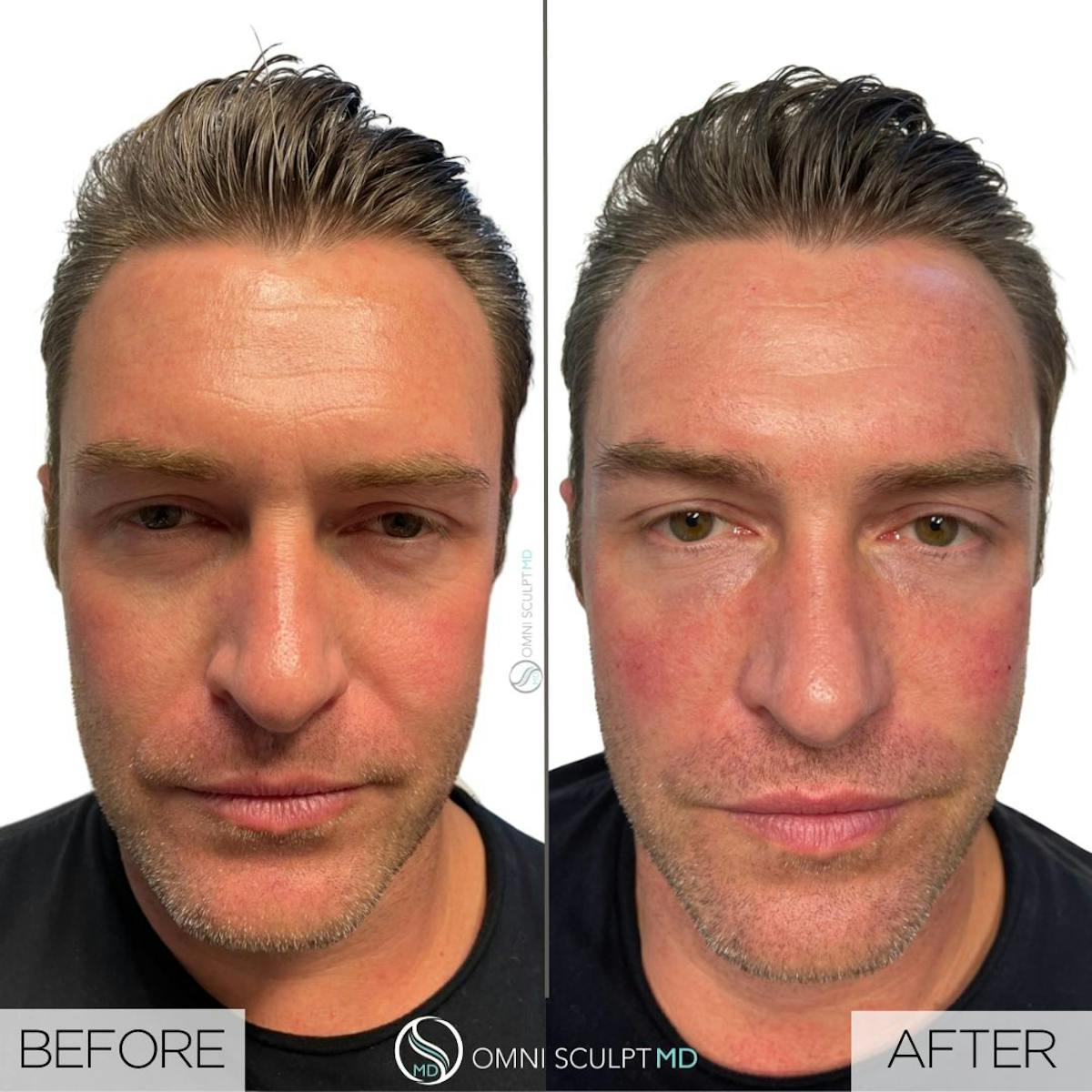 Under Eye & Cheeks Before & After Gallery - Patient 717386 - Image 1