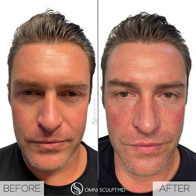 Under Eye & Cheeks Before & After Gallery - Patient 717386 - Image 1