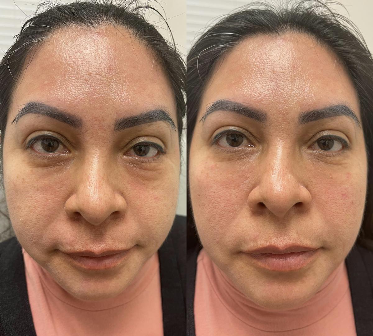 Under Eye & Cheeks Before & After Gallery - Patient 284147 - Image 1
