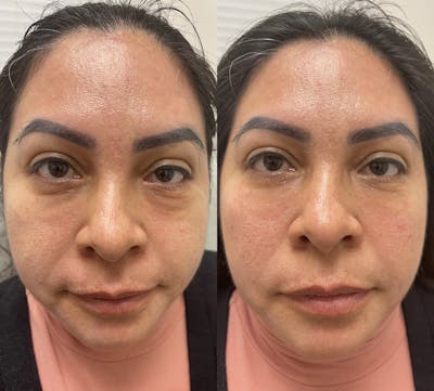 Under Eye & Cheeks Before & After Gallery - Patient 284147 - Image 1