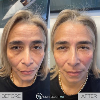 Under Eye & Cheeks Before & After Gallery - Patient 331245 - Image 1