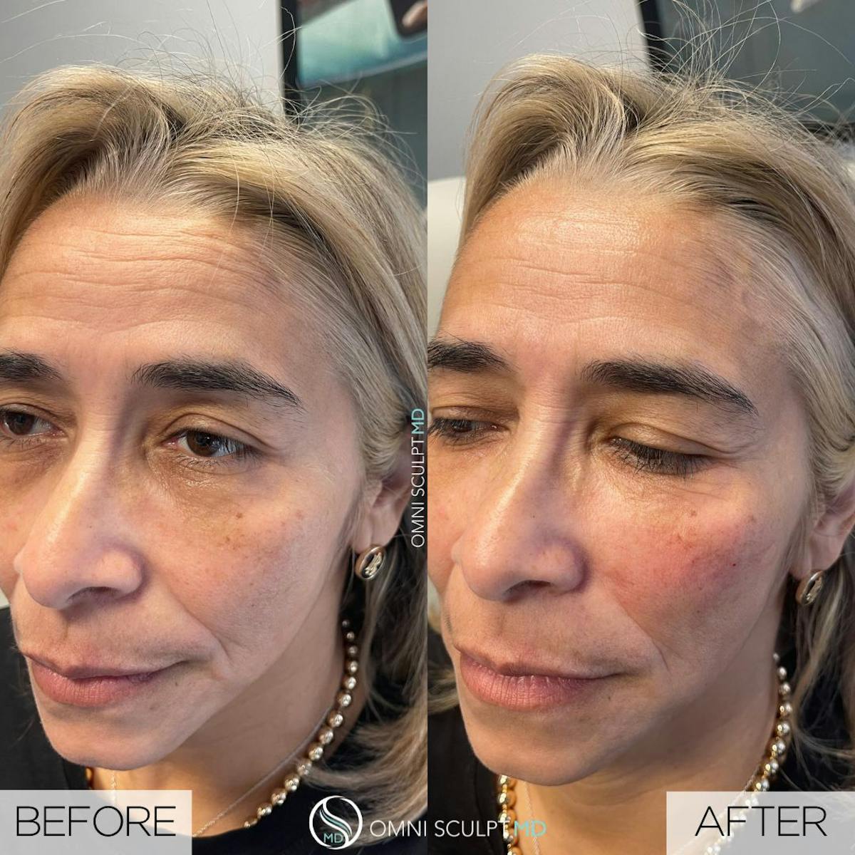 Under Eye & Cheeks Before & After Gallery - Patient 245133 - Image 2