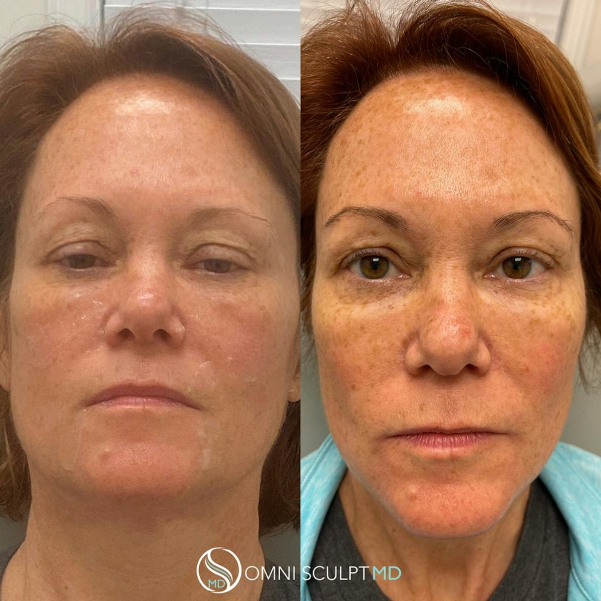 Under Eye & Cheeks Before & After Gallery - Patient 201818 - Image 1