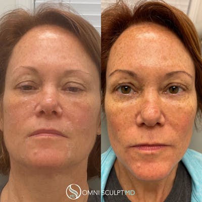Under Eye & Cheeks Before & After Gallery - Patient 201818 - Image 1