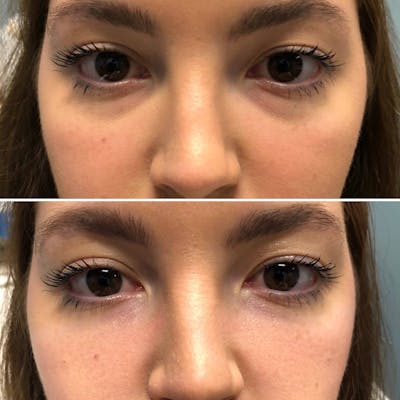 Under Eye & Cheeks Before & After Gallery - Patient 344889 - Image 1
