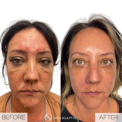 Under Eye & Cheeks Before & After Gallery - Patient 360569 - Image 1