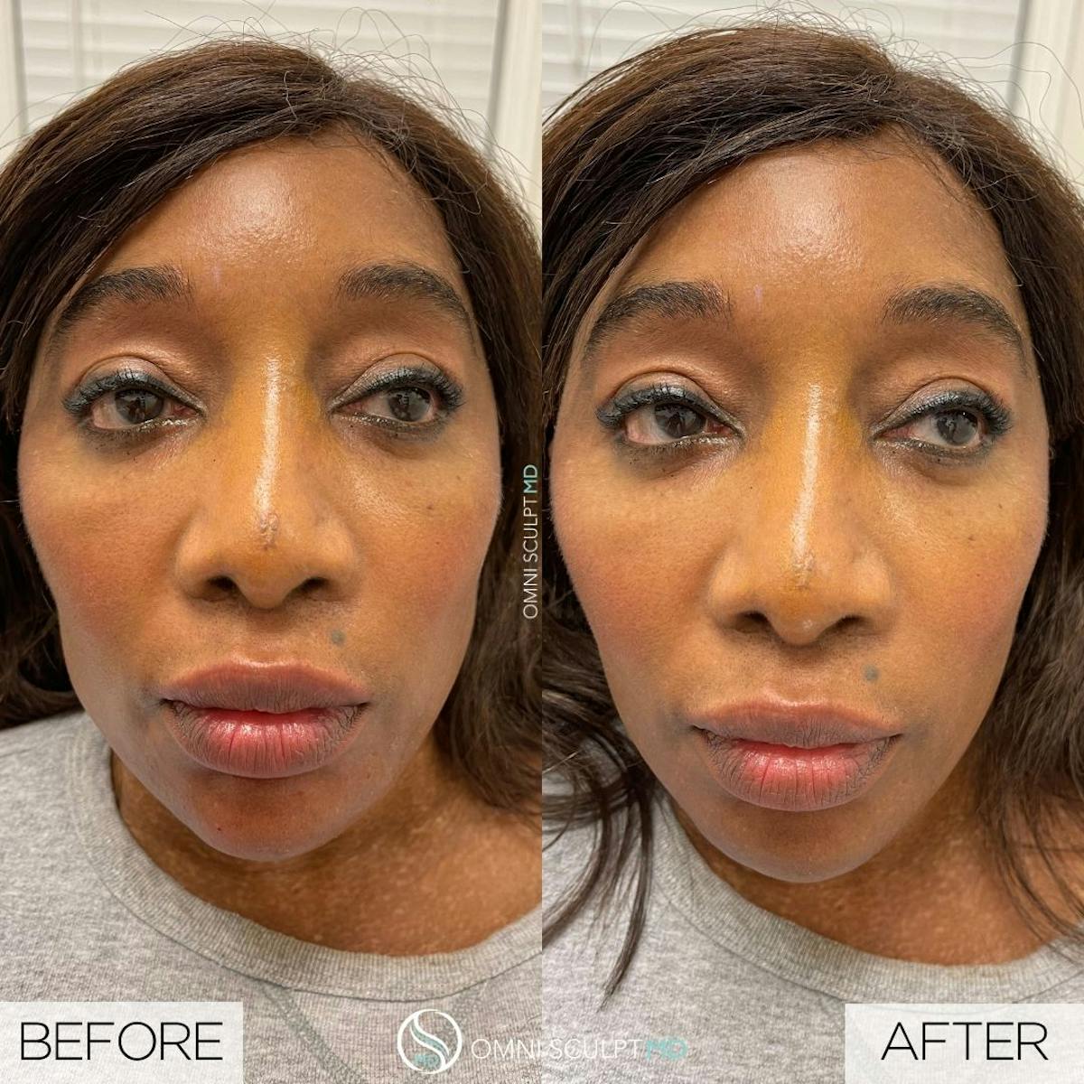 Under Eye & Cheeks Before & After Gallery - Patient 374930 - Image 1