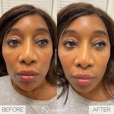 Under Eye & Cheeks Before & After Gallery - Patient 374930 - Image 1