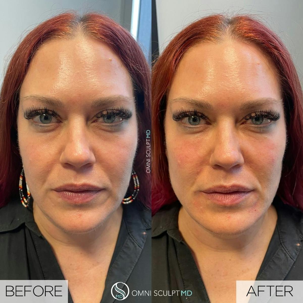 Under Eye & Cheeks Before & After Gallery - Patient 119208 - Image 1