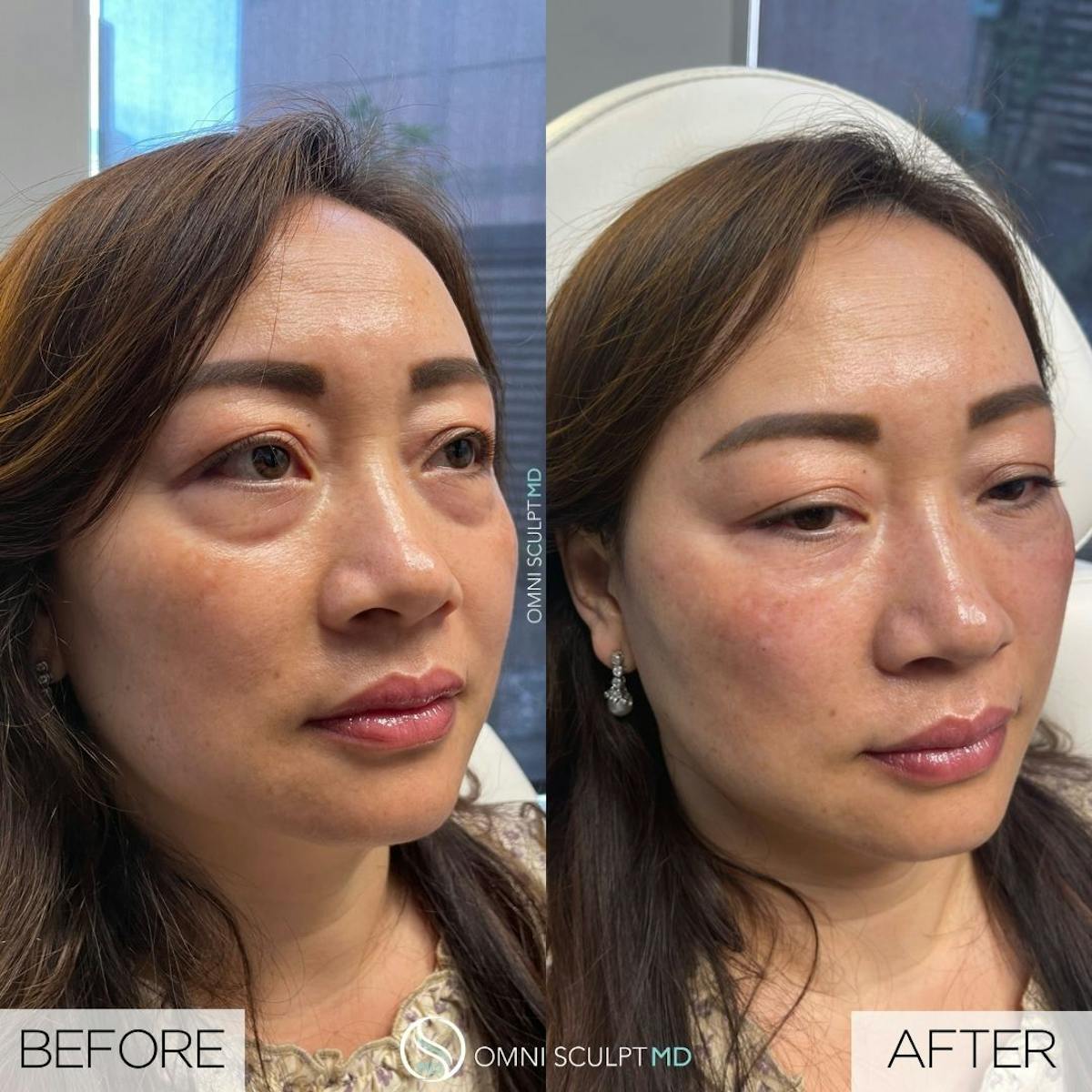 Under Eye & Cheeks Before & After Gallery - Patient 219450 - Image 1