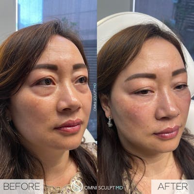 Under Eye & Cheeks Before & After Gallery - Patient 219450 - Image 1
