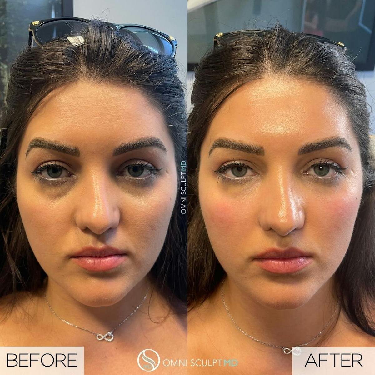 Under Eye & Cheeks Before & After Gallery - Patient 417779 - Image 1
