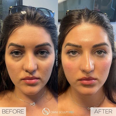 Under Eye & Cheeks Before & After Gallery - Patient 417779 - Image 1