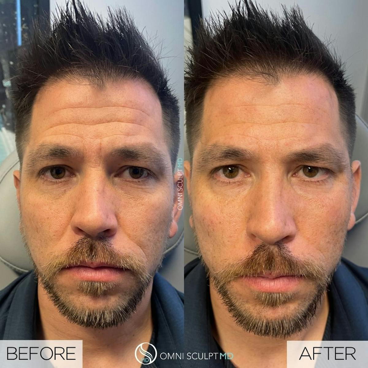 Under Eye & Cheeks Before & After Gallery - Patient 178263 - Image 1