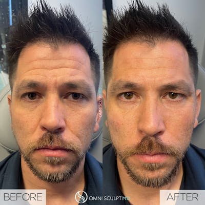 Under Eye & Cheeks Before & After Gallery - Patient 178263 - Image 1