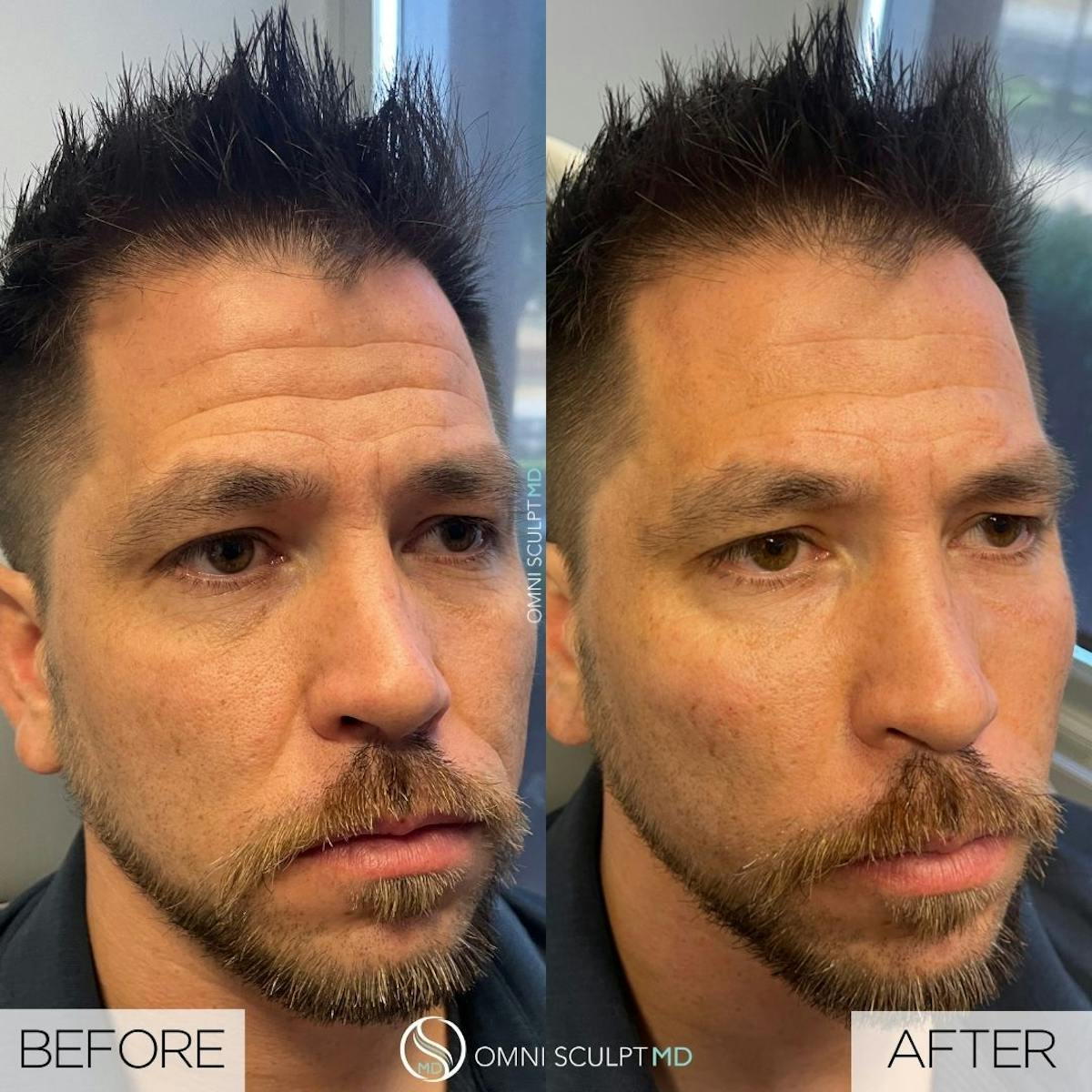 Under Eye & Cheeks Before & After Gallery - Patient 178263 - Image 2