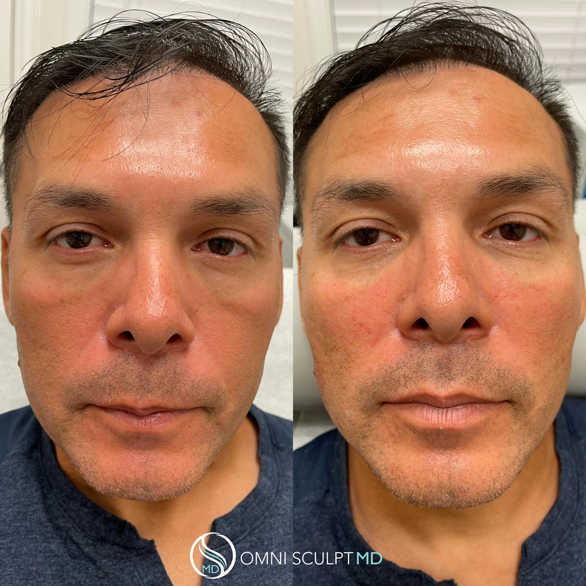 Under Eye & Cheeks Before & After Gallery - Patient 362773 - Image 1