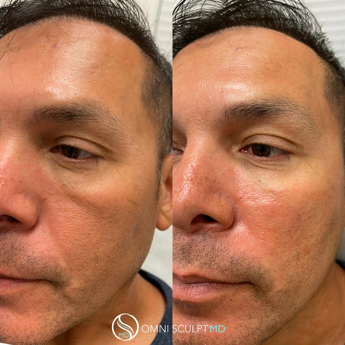 Under Eye & Cheeks Before & After Gallery - Patient 362773 - Image 2
