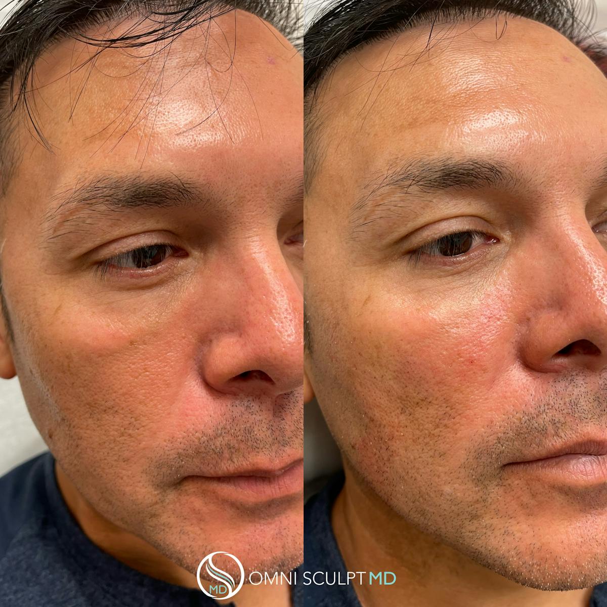 Under Eye & Cheeks Before & After Gallery - Patient 362773 - Image 3