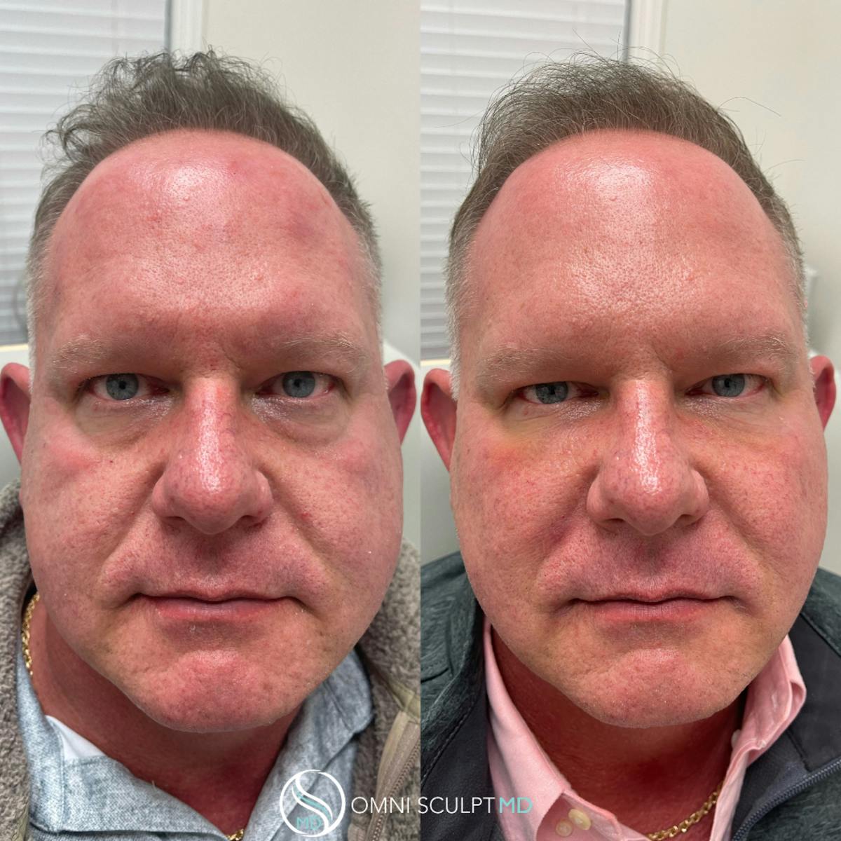 Under Eye & Cheeks Before & After Gallery - Patient 428152 - Image 1