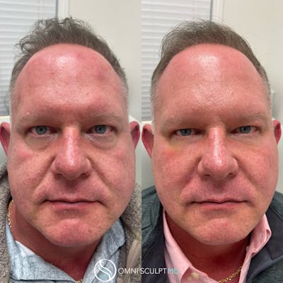Under Eye & Cheeks Before & After Gallery - Patient 428152 - Image 1
