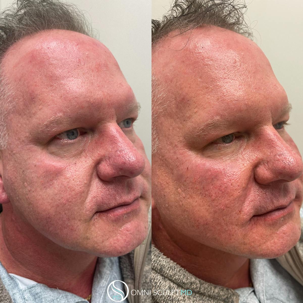 Under Eye & Cheeks Before & After Gallery - Patient 428152 - Image 2