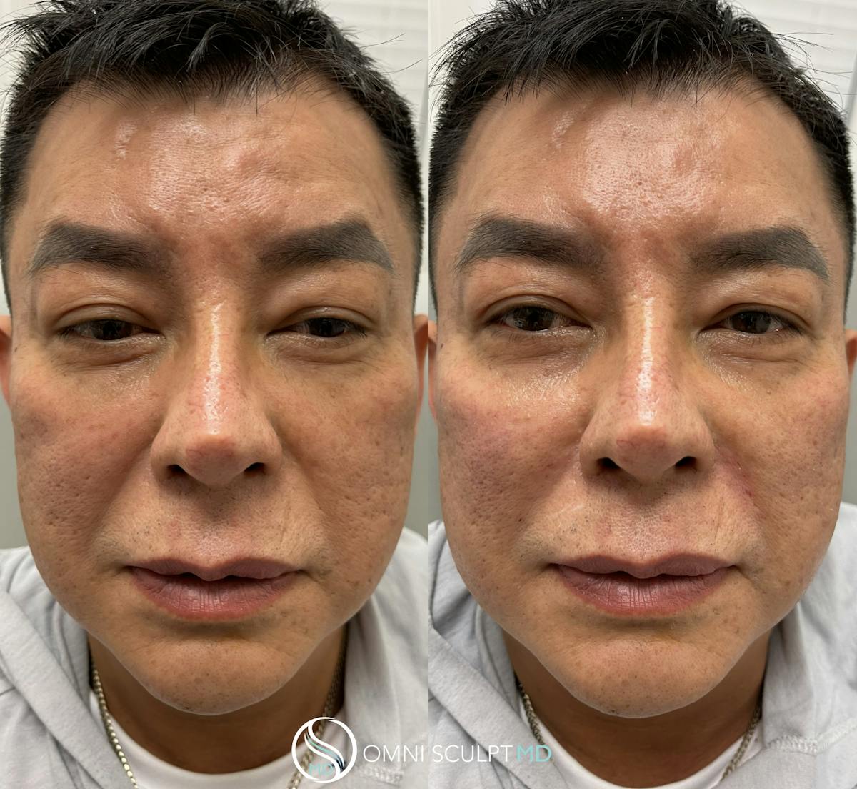 Under Eye & Cheeks Before & After Gallery - Patient 294326 - Image 1