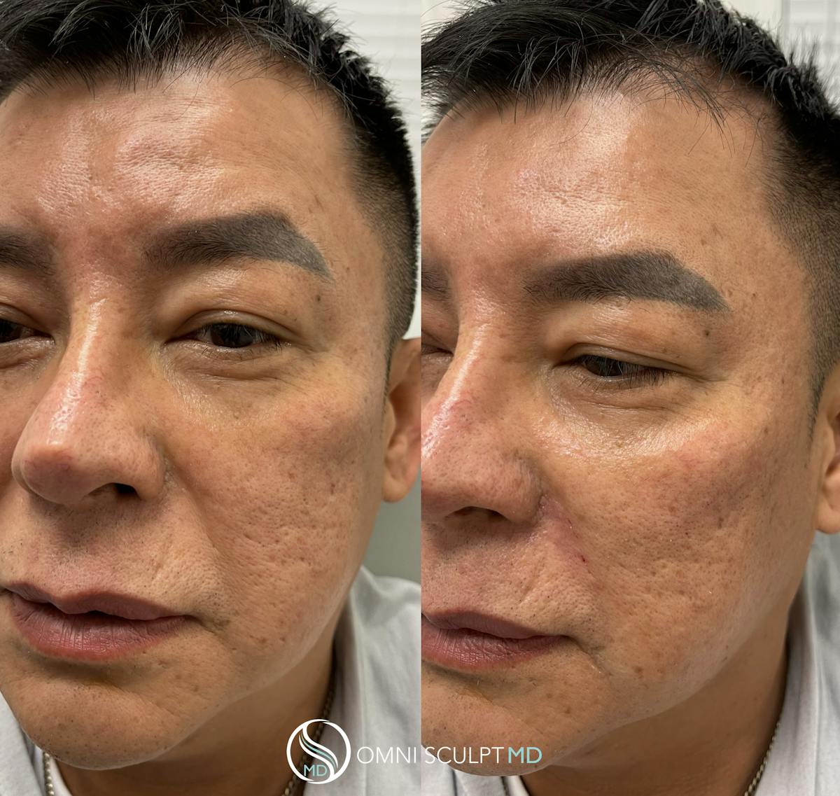 Under Eye & Cheeks Before & After Gallery - Patient 294326 - Image 2
