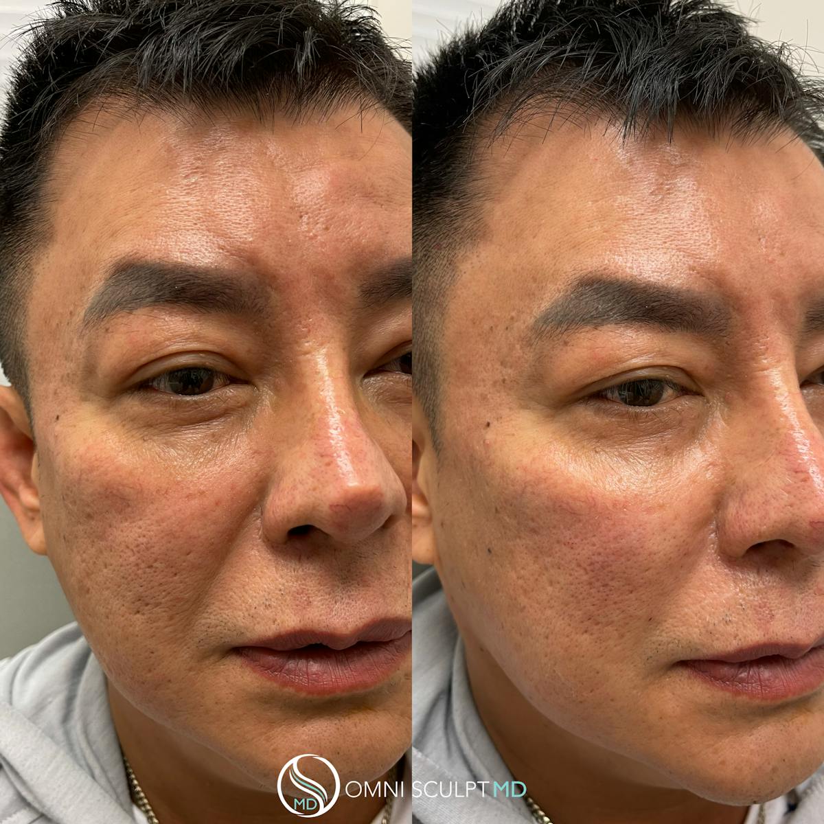 Under Eye & Cheeks Before & After Gallery - Patient 294326 - Image 3