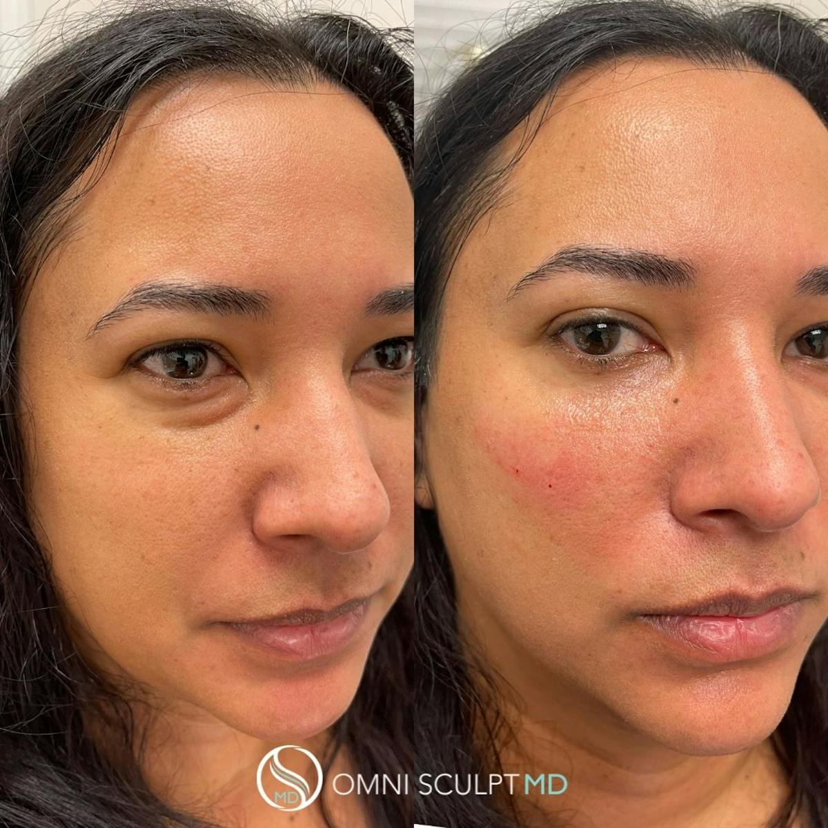Under Eye & Cheeks Before & After Gallery - Patient 123621 - Image 1