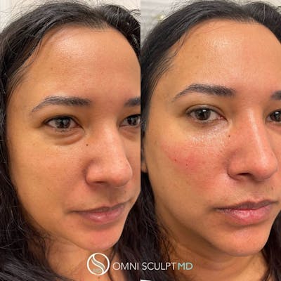 Under Eye & Cheeks Before & After Gallery - Patient 123621 - Image 1