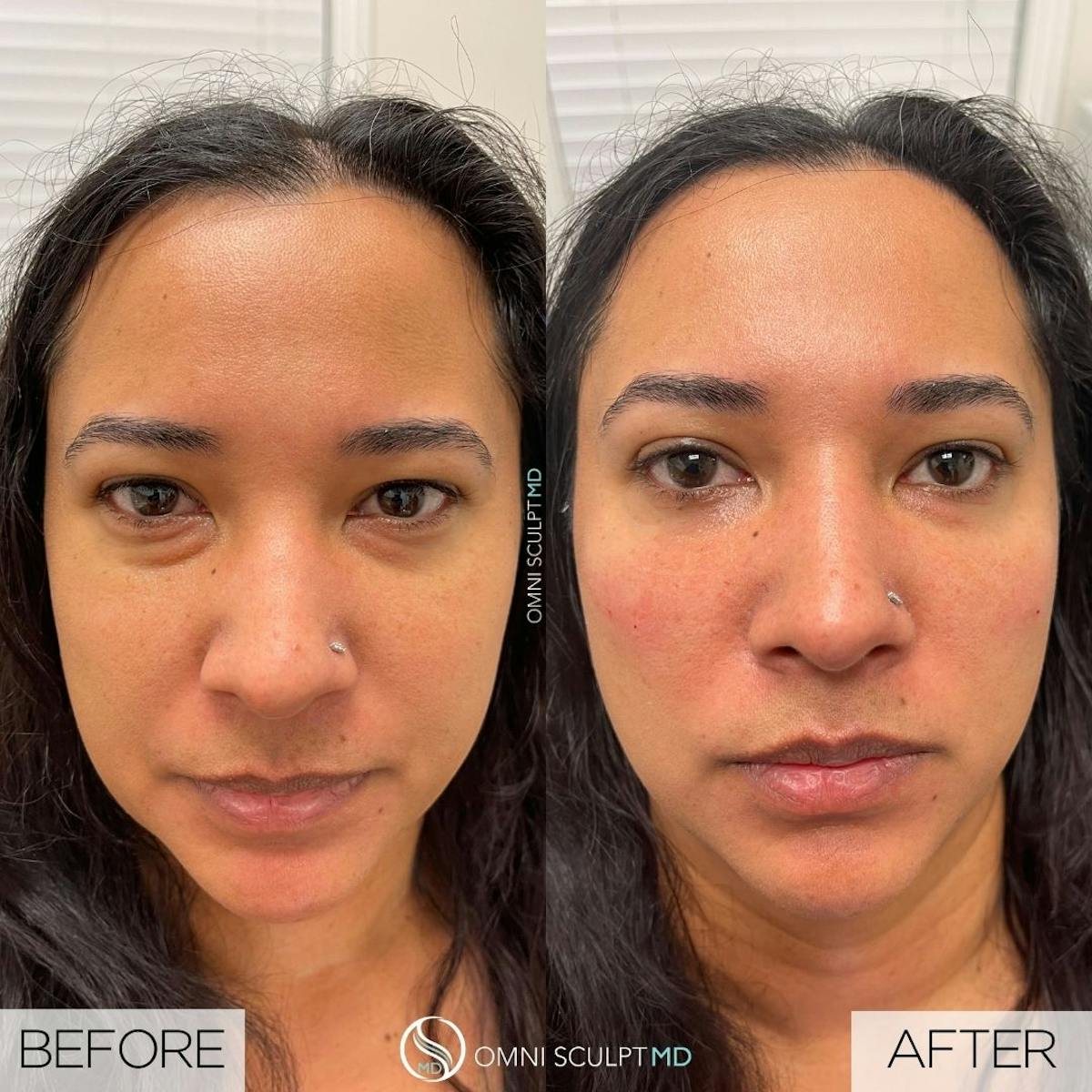 Under Eye & Cheeks Before & After Gallery - Patient 123621 - Image 2