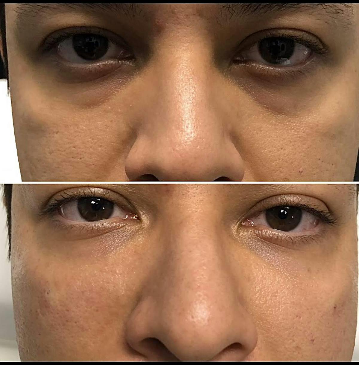 Under Eye & Cheeks Before & After Gallery - Patient 396607 - Image 1