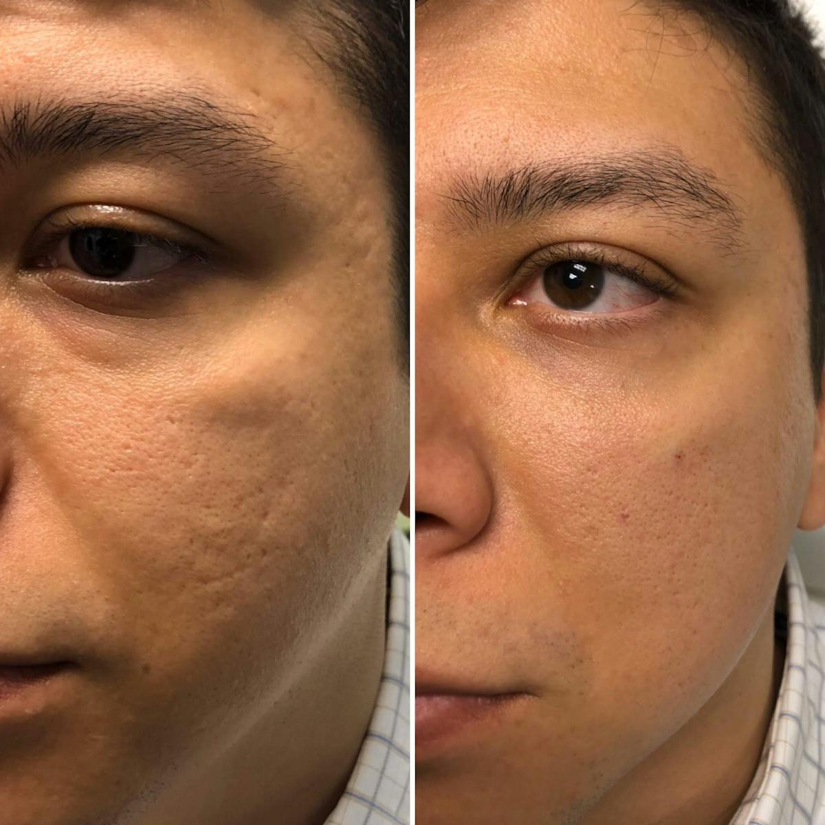 Under Eye & Cheeks Before & After Gallery - Patient 396607 - Image 2