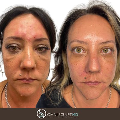 Full Facial Rejuvenation Before & After Gallery - Patient 231781 - Image 1