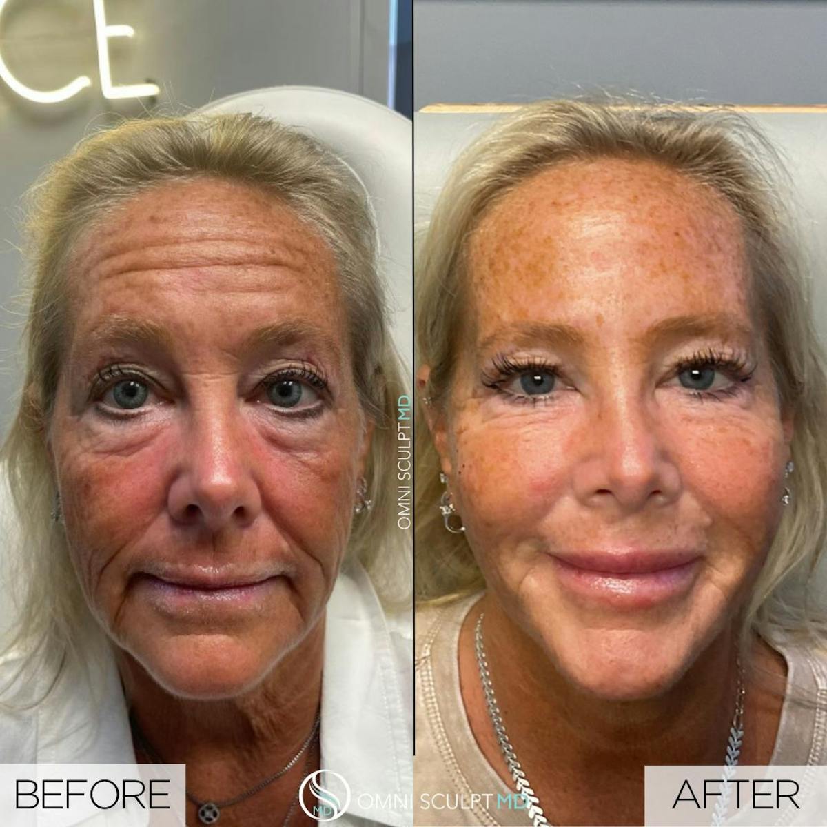 Full Facial Rejuvenation Before & After Gallery - Patient 108357 - Image 1
